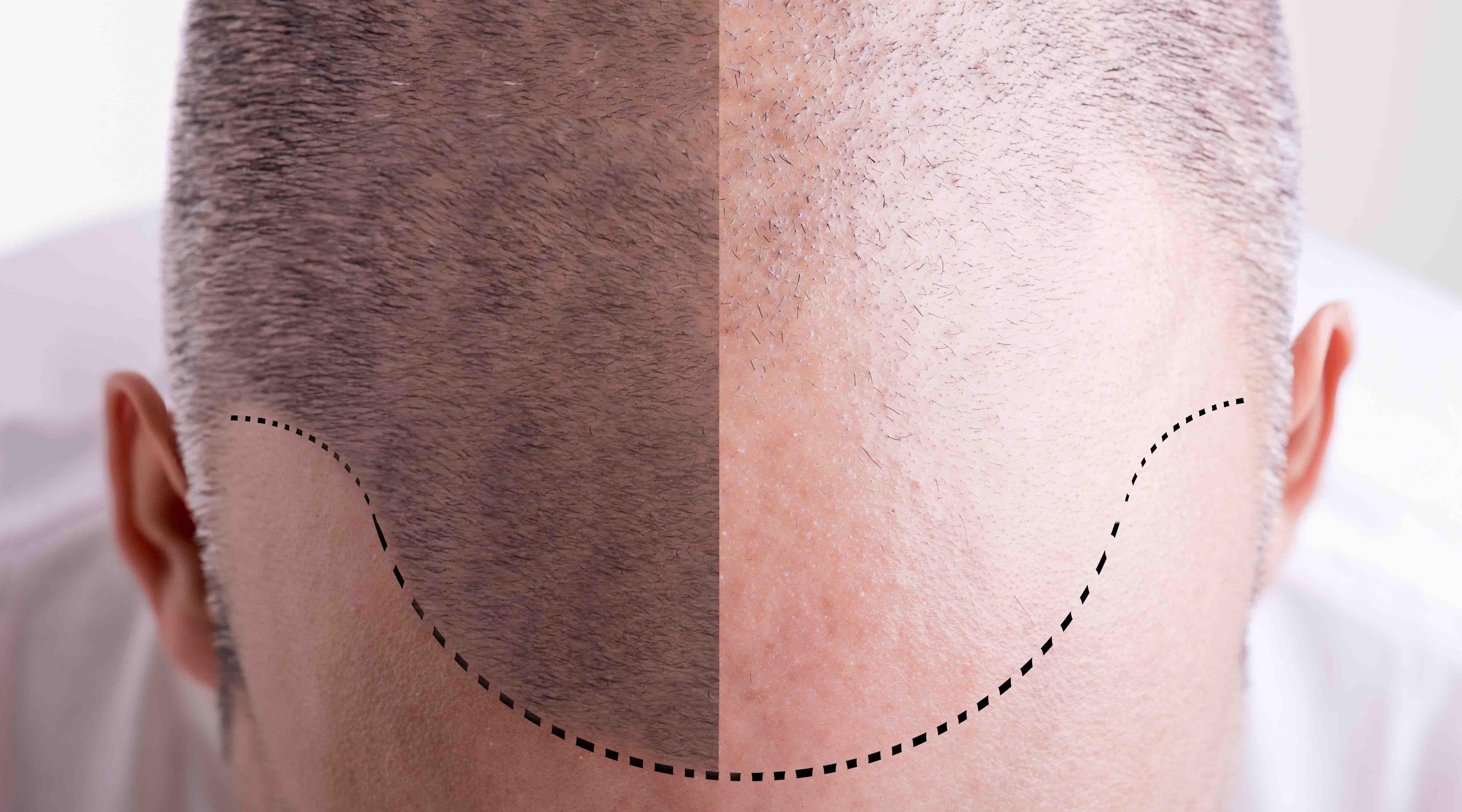 BAHRS partners with CQC to create inspection guide to promote safety for hair restoration