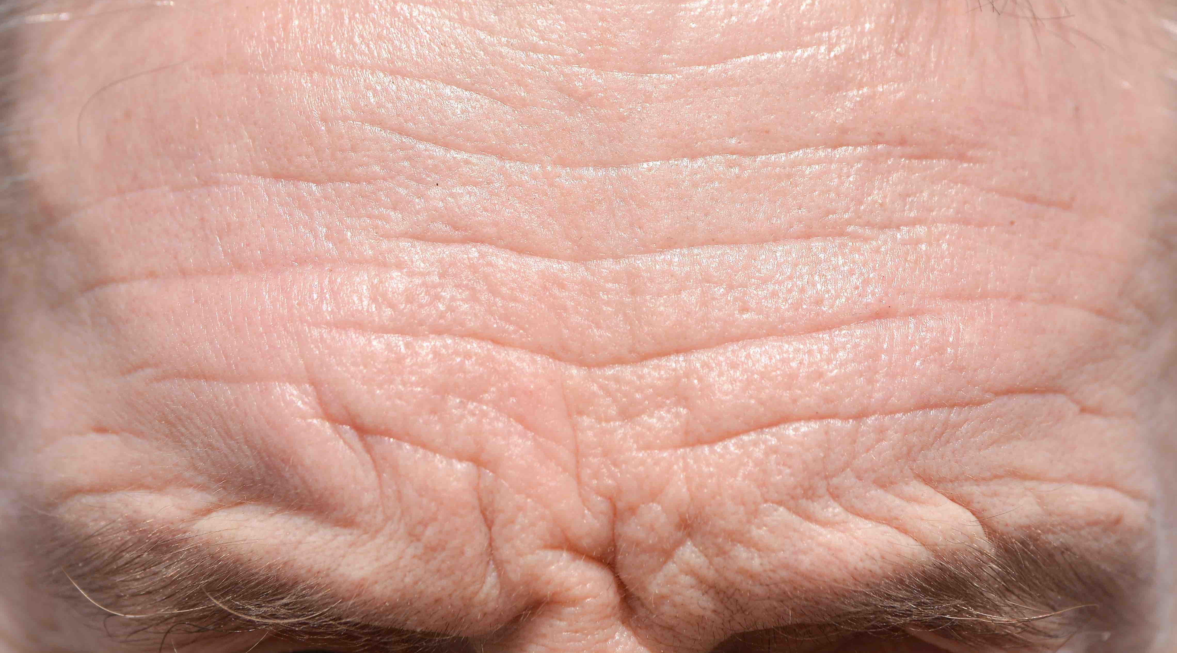 FDA approves Botox Cosmetic for Forehead Lines 