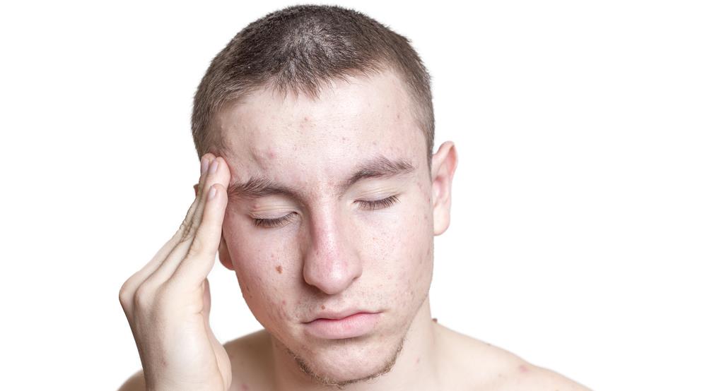 Verbal abuse experienced by more than half of acne suffers