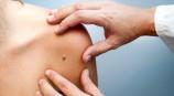 UK Enquiries for mole removal up 127%