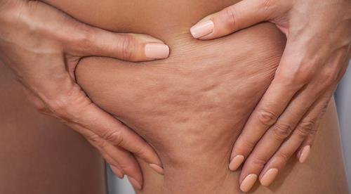 Merz Aesthetics to launch new cellulite treatment 