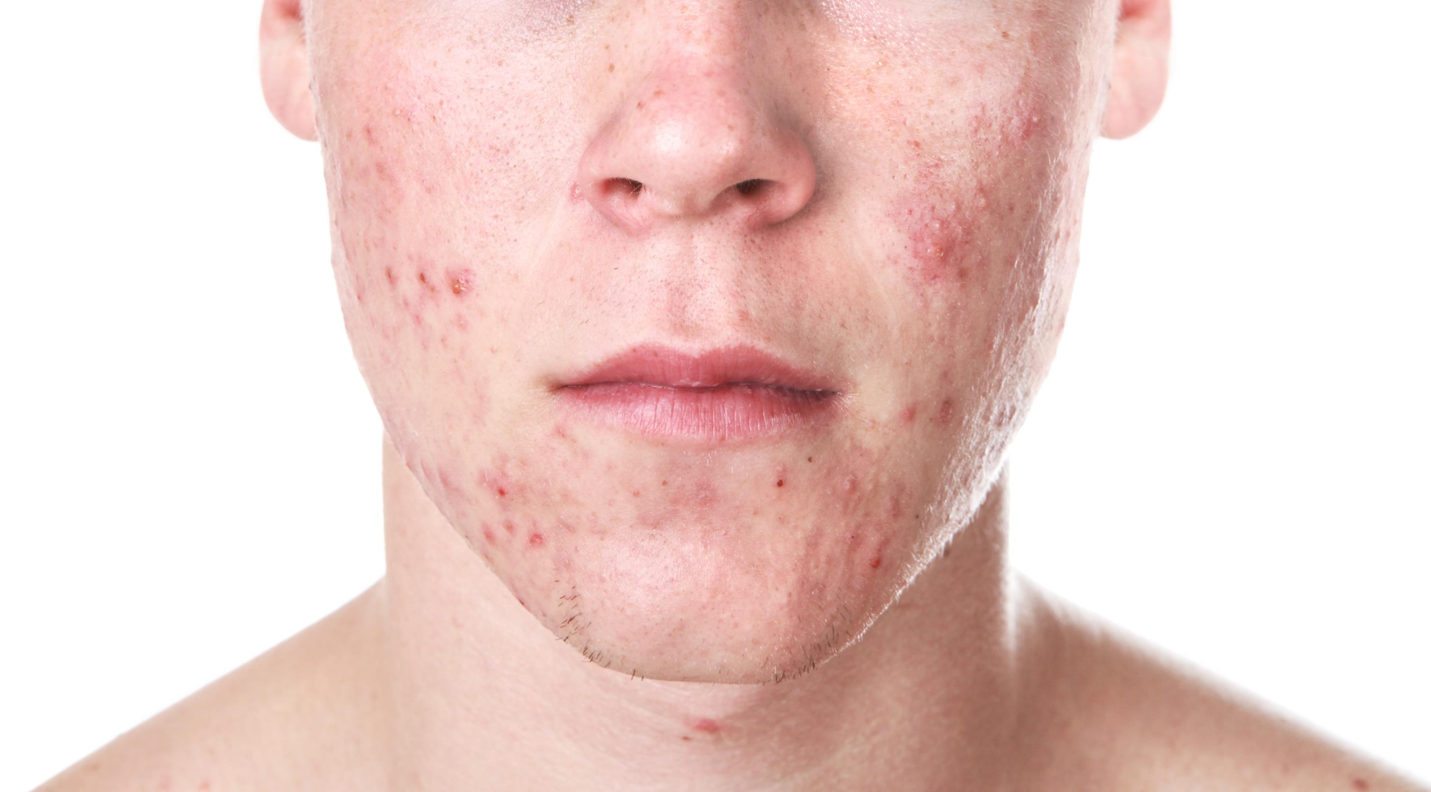 Up to 20% of patients with acne also suffer from social and psychological problems