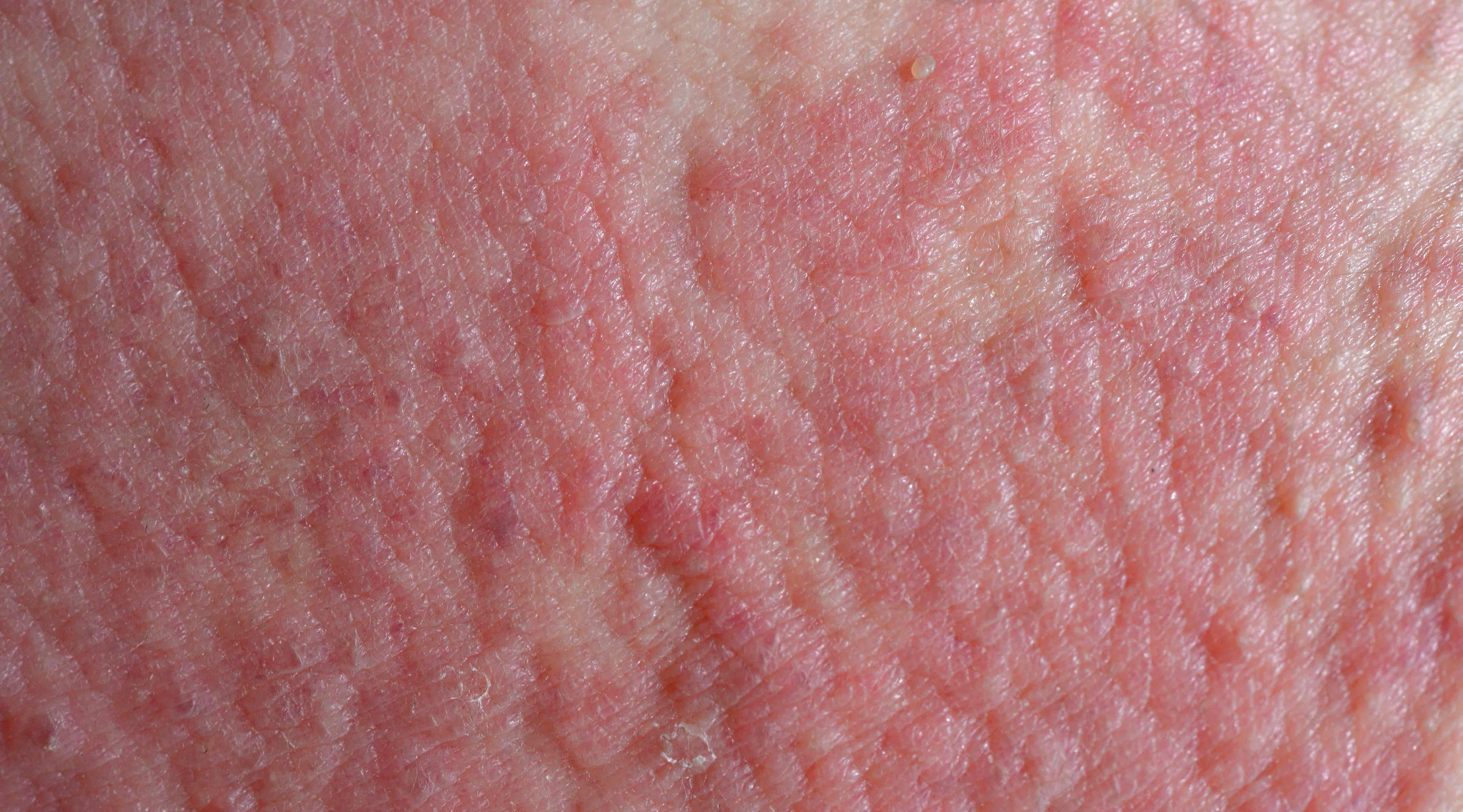New mechanism underlying IL-31-induced atopic dermatitis