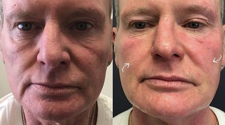 Paul Gascoigne has ClearLift Laser facial to correct years of alcohol abuse