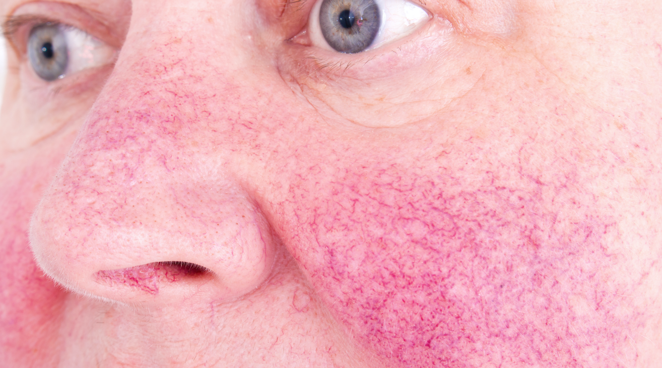 Scientists make breakthrough in rosacea treatment research