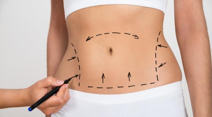 Cynosure Receives FDA 510(k) clearance for SculpSure™