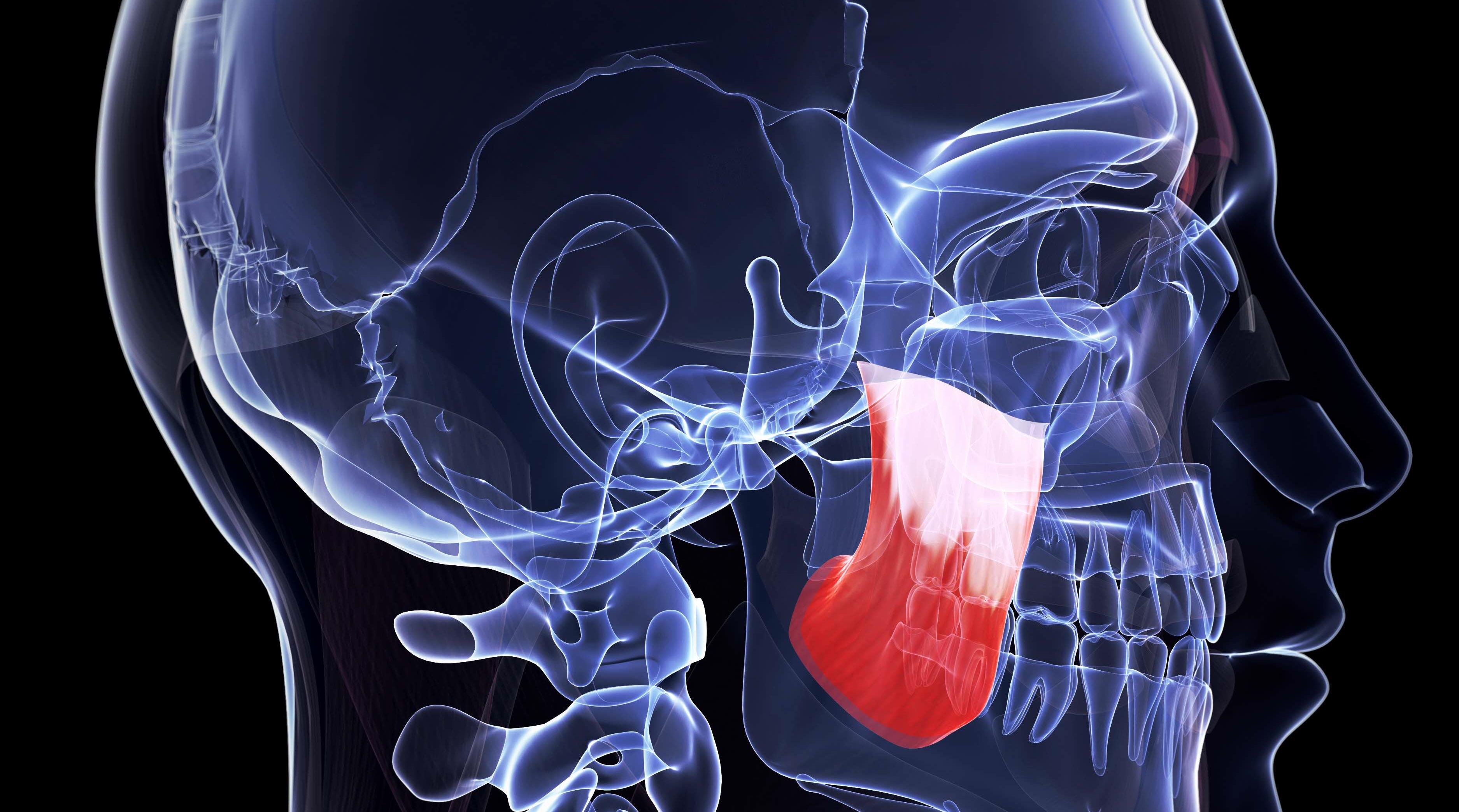 Study examines complication rates of toxin injection in masseter