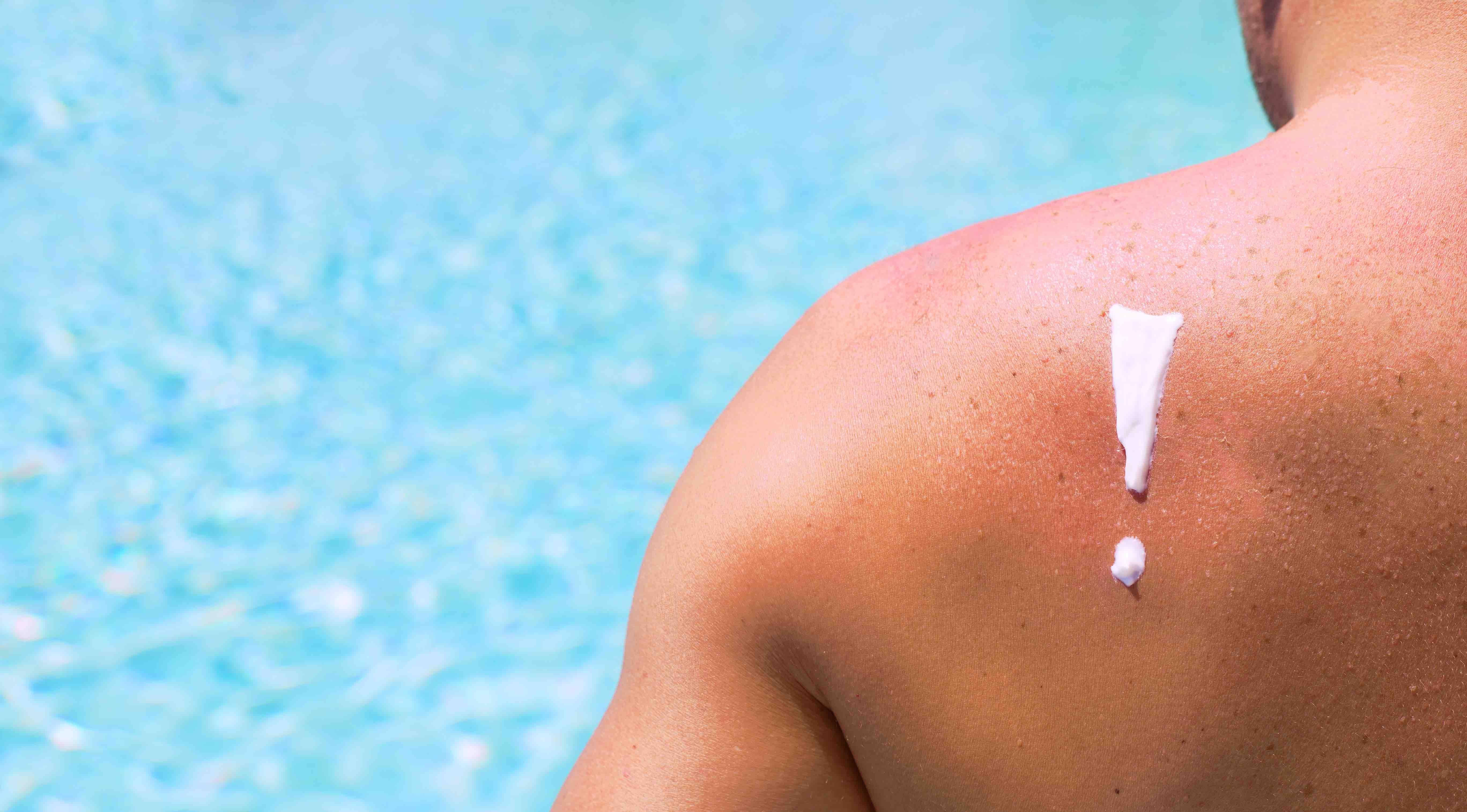 NICE publishes new guidelines on sunlight exposure