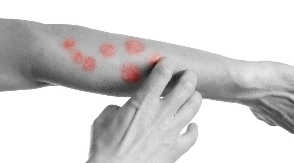 EU ban for irritant preservatives MI and MCI