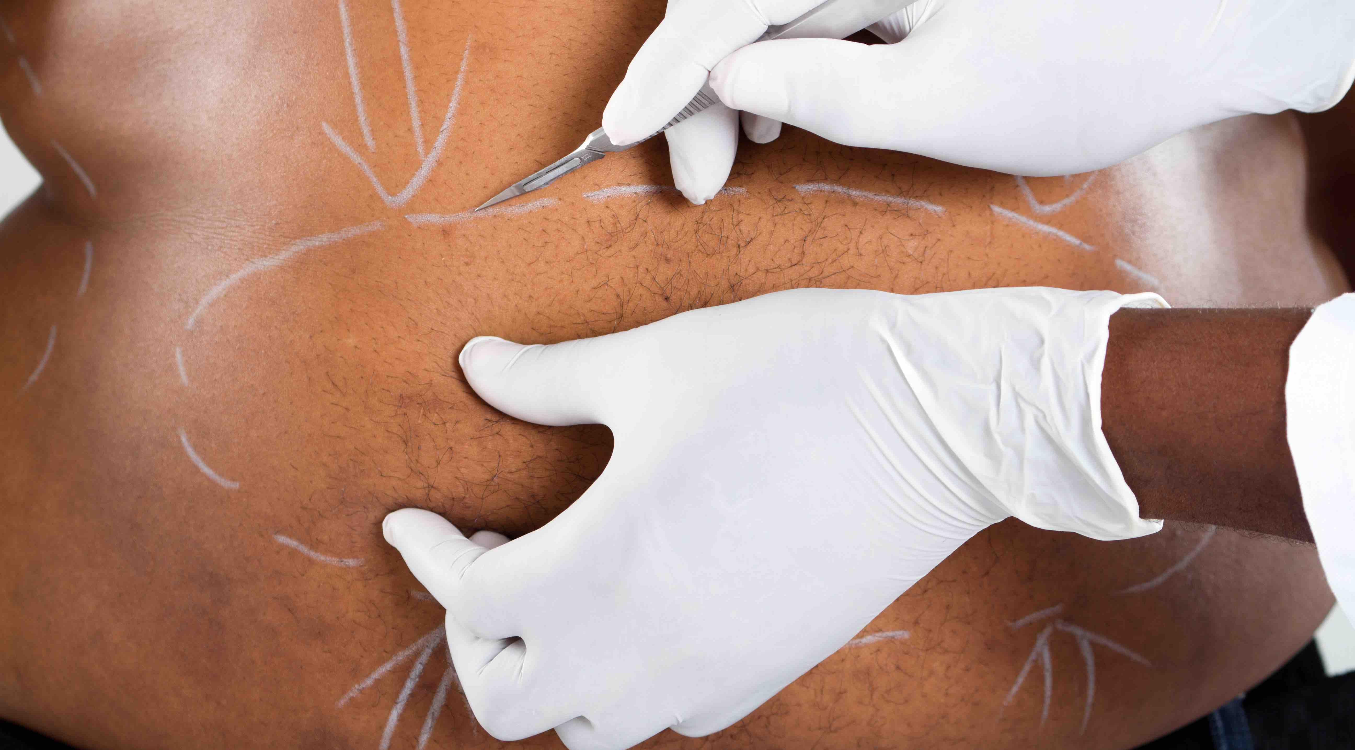 90% of CCGs ignoring guidelines by not offering lifesaving surgery to obesity patients 