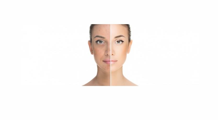 Pigmentation 