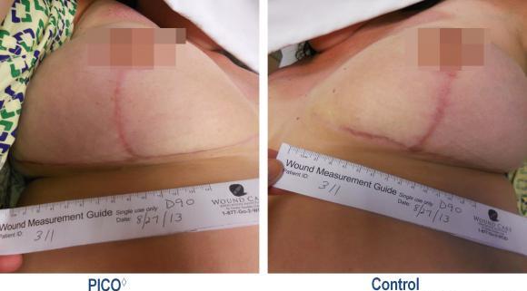 Fewer healing complications and improved scar quality with PICO NPWT System 