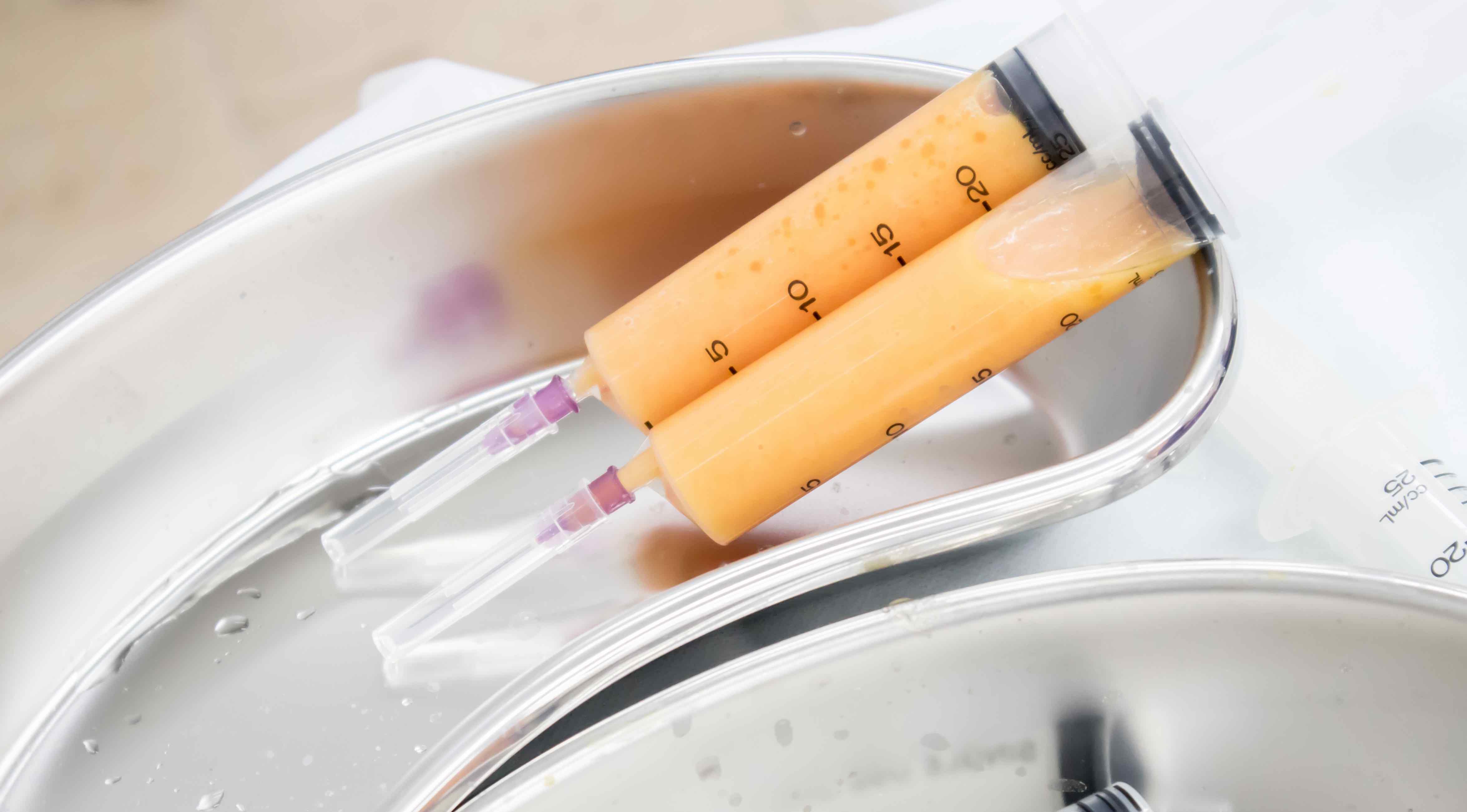 New plastic surgery statistics reveal focus on fat 