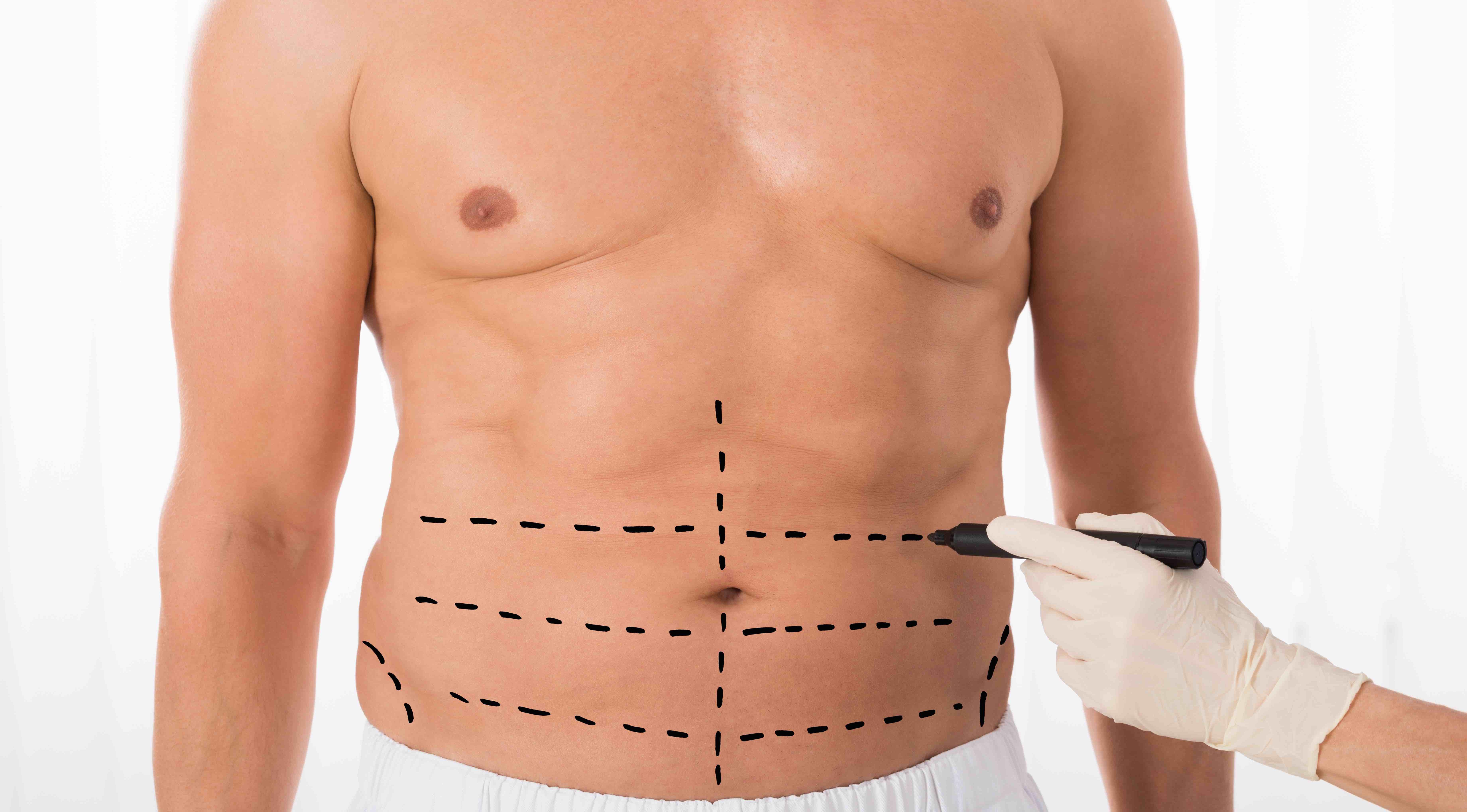 Increasing male demand for liposuction will lift body contouring market to $1.1 billion by 2022