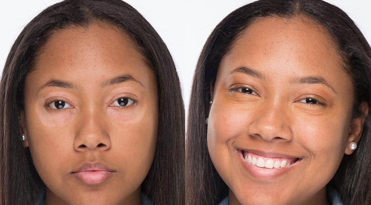 Wellness Trading distributes new vitiligo product in the UK