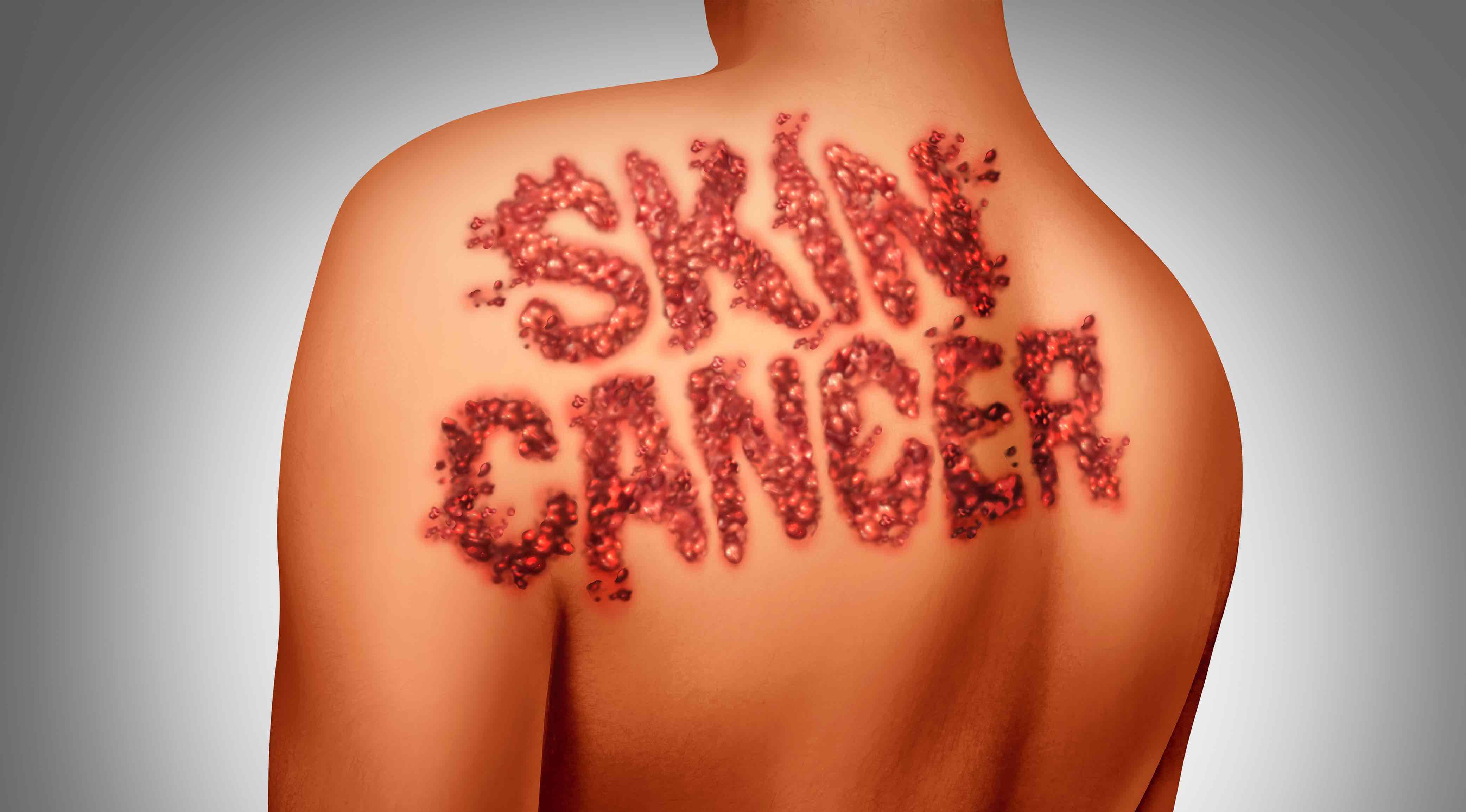 Men’s skin cancer knowledge lags behind women’s, according to AAD