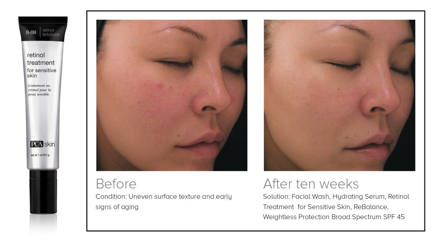 Sponsored Feature: PCA SKIN UK Launches Retinol Treatment for Sensitive Skin