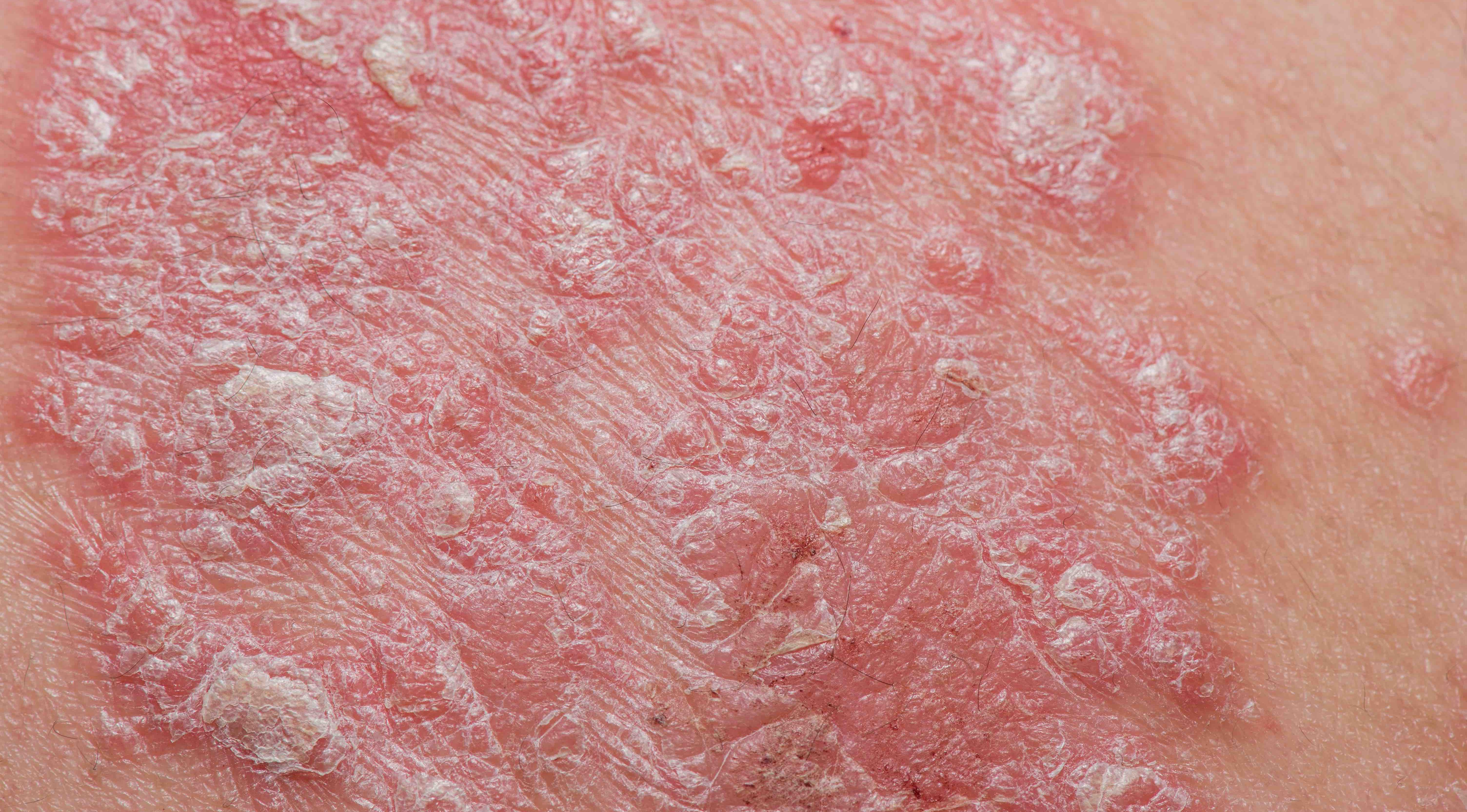 The European Commission approves Skilarence® for moderate-to-severe chronic plaque Psoriasis