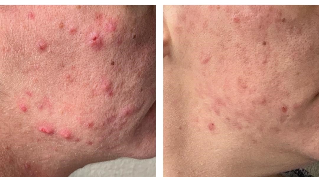 The benefits of using probiotic skincare to treat acne