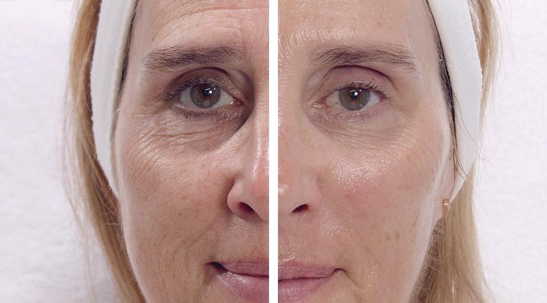 Non-invasive treatments for rejuvenating skin