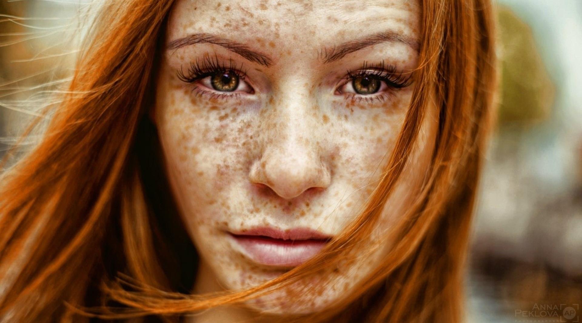 The freckle factor 