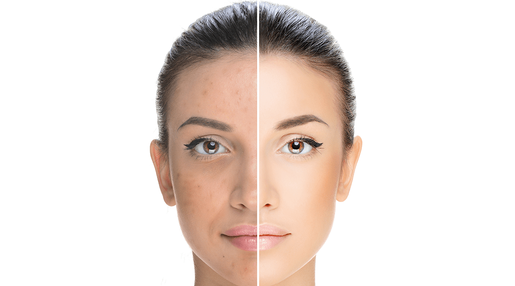 June Acne Awareness Month