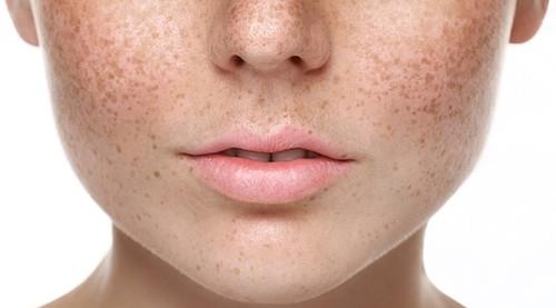 Why does pigmentation appear differently on some skin tones?