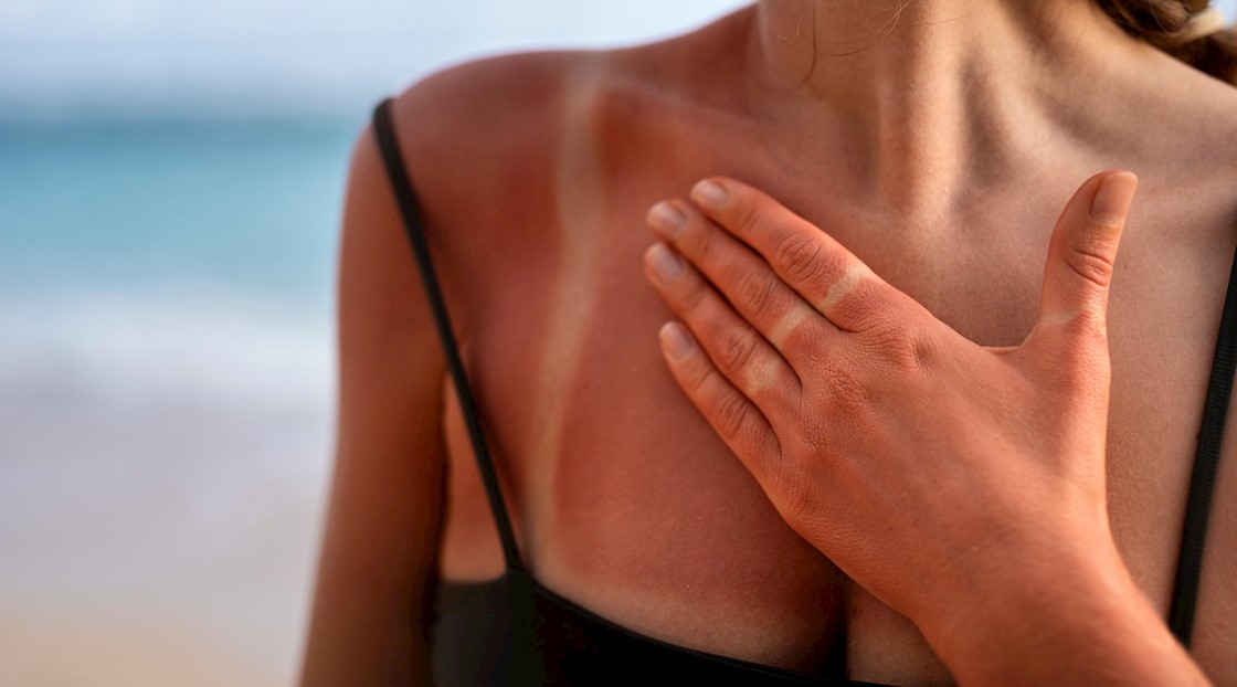 More than half of Brits get sunburnt accidentally