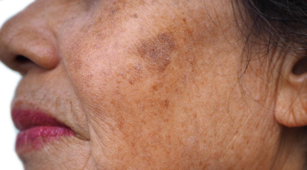 Study finds melasma improvement with PRP