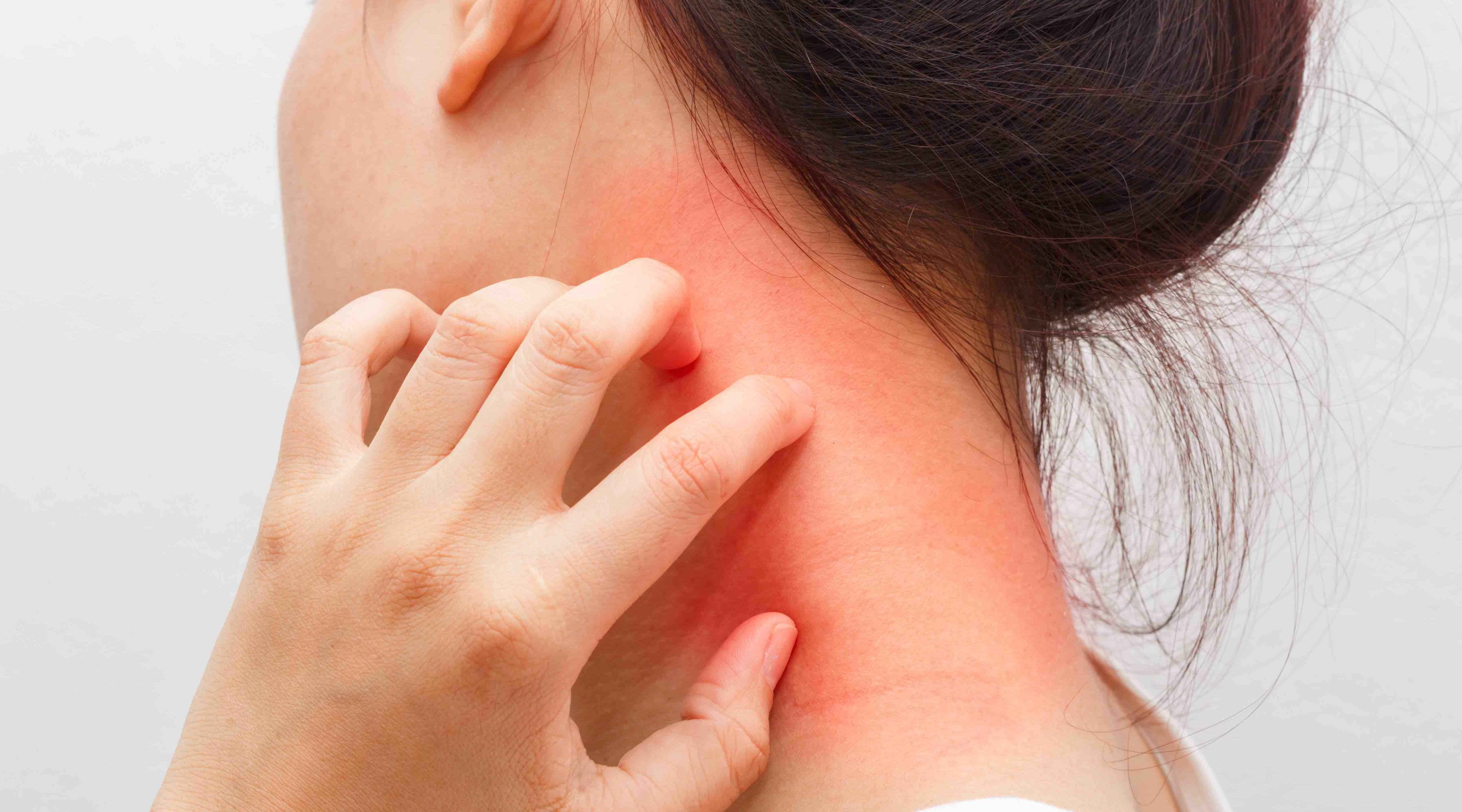 Could contact dermatitis be prevented? 