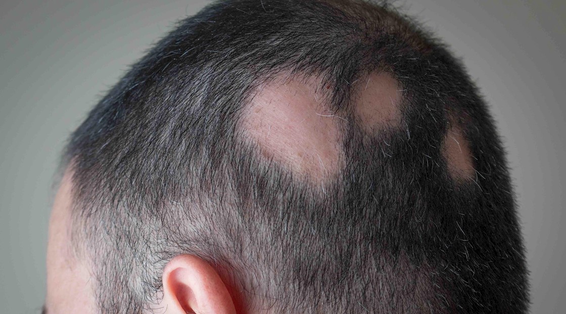 Can antihistamine treatment improve hair regrowth?