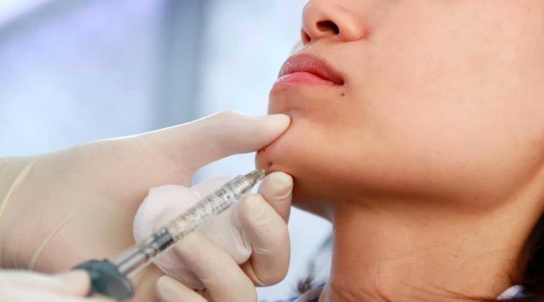 HA filler bone resorption