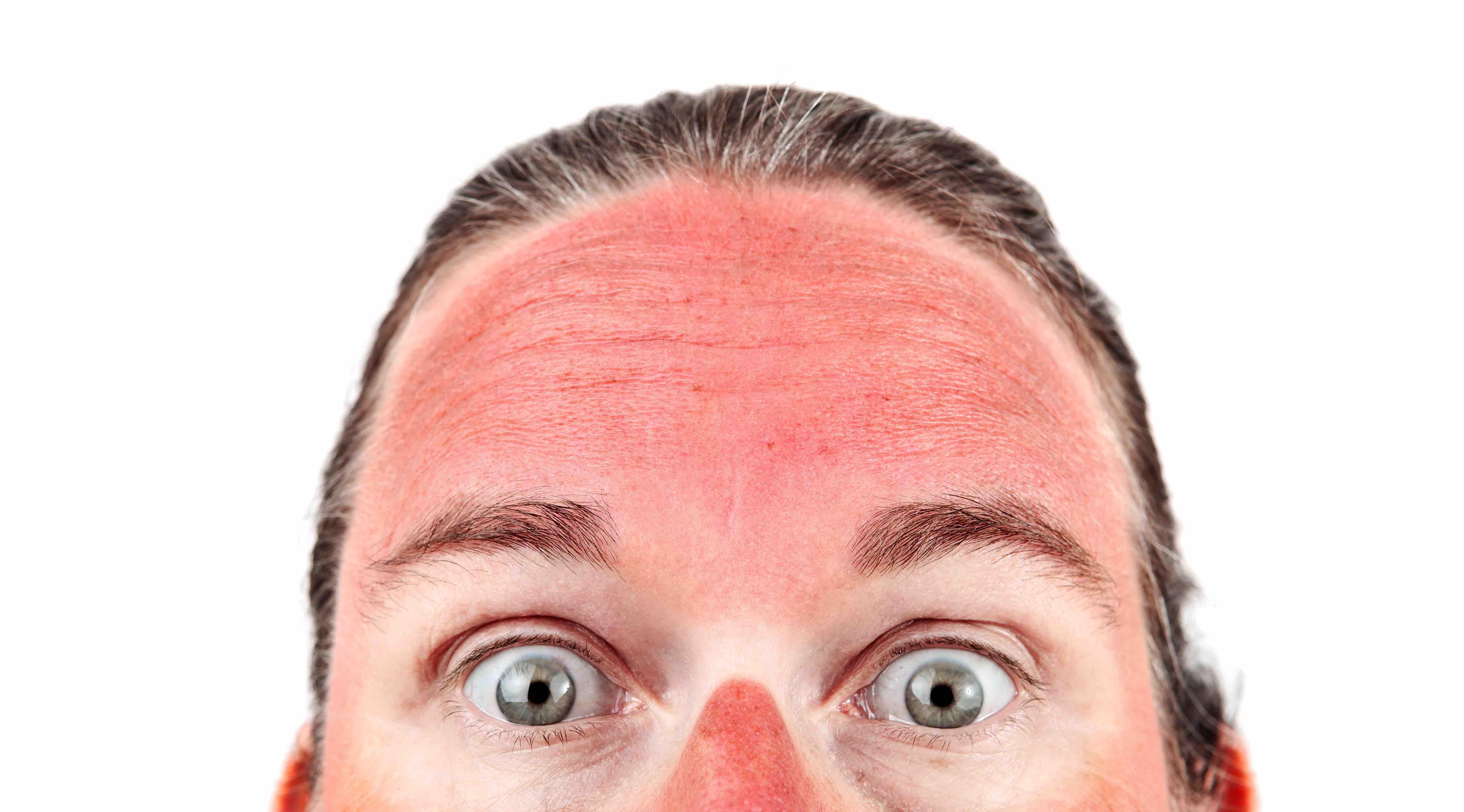 BAD launches Sun Awareness campaign this month