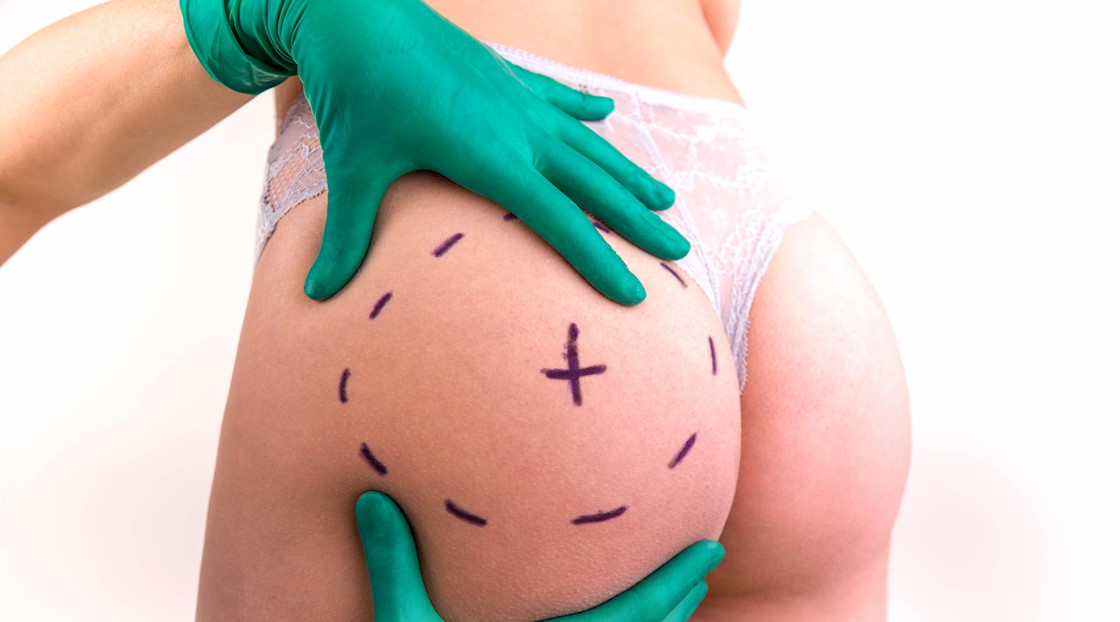 Exploring the controversy of Brazilian butt lifts
