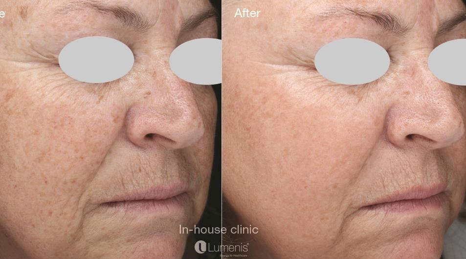 How more radiant skin is possible for your patients with Lumenis Photofabulous™ complete skin rejuvenation 