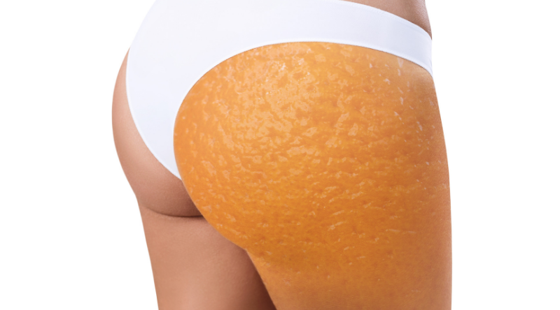 Discover the latest treatments to fight cellulite at Aesthetic Medicine Live