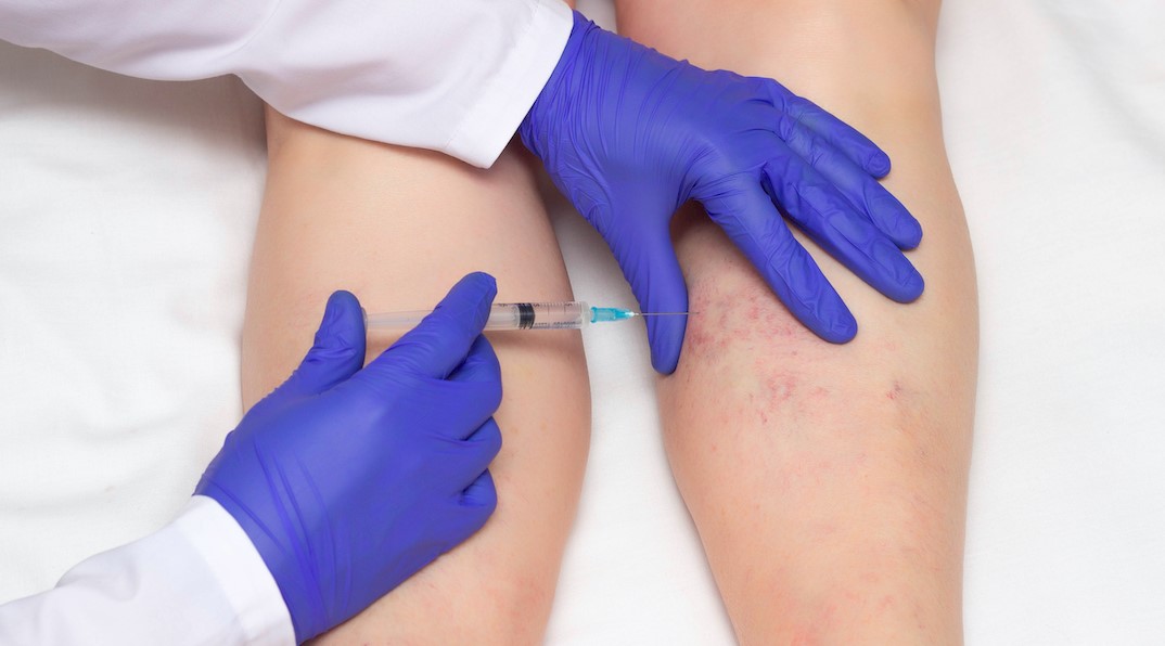BAS to host virtual vein treatment masterclass 
