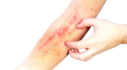 Almirall Exercises its Option with Dermira to License Rights to Lebrikizumab in Europe for atopic dermatitis