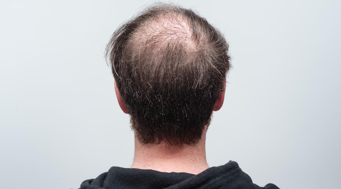New ruling issued about hair loss medication advertising