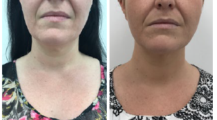 Editor's Choice: Profhilo and Aliaxin SR