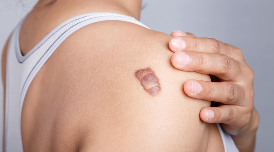 Contribute to new survey on keloid scars