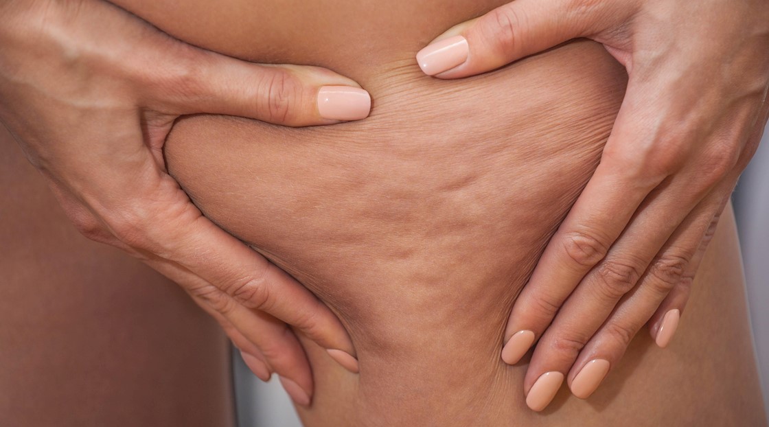 Survey suggests that cellulite is noted more by other women than by men
