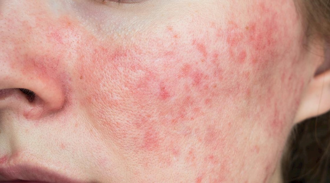 These were the UK's biggest skin concerns last year