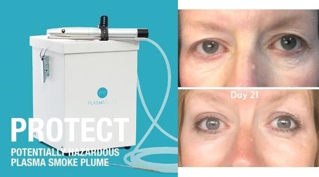 Sponsored story: How to choose a plasma machine