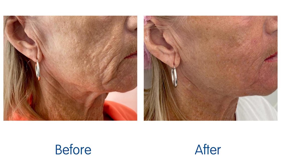 How to give skin back its snap