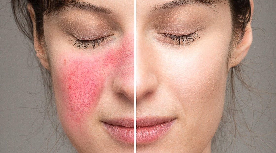 How stress displays on the skin, and how to address it