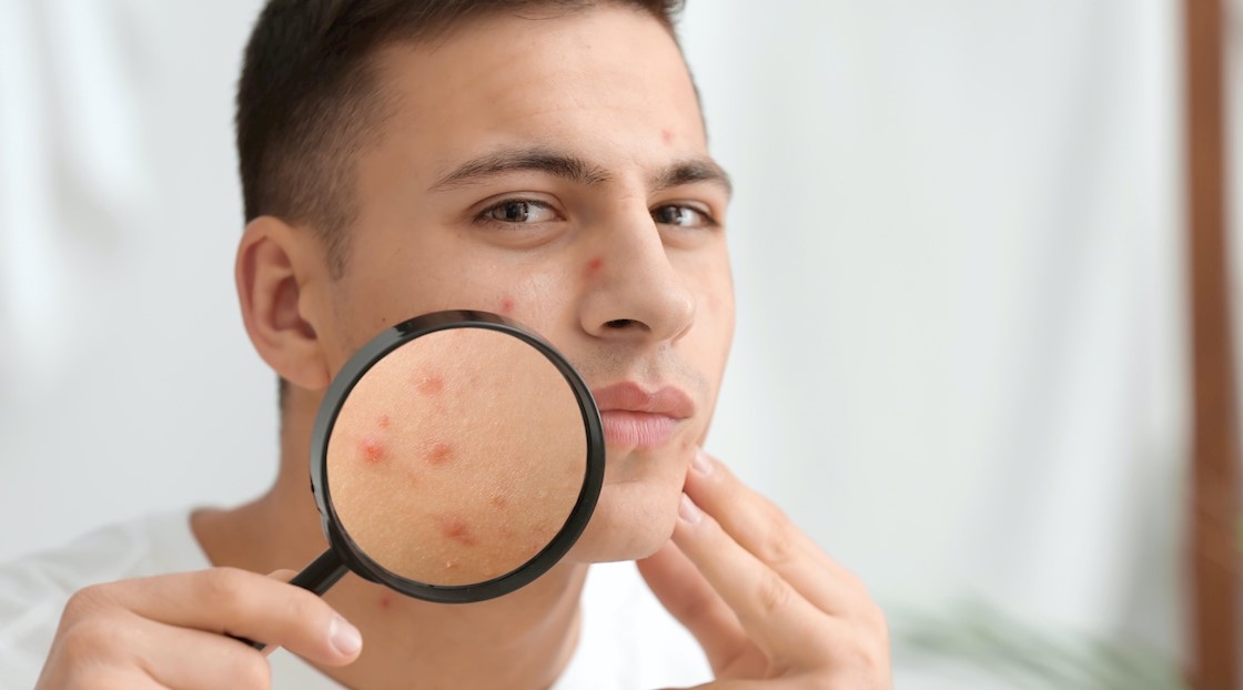 How to treat acne depending on how it presents