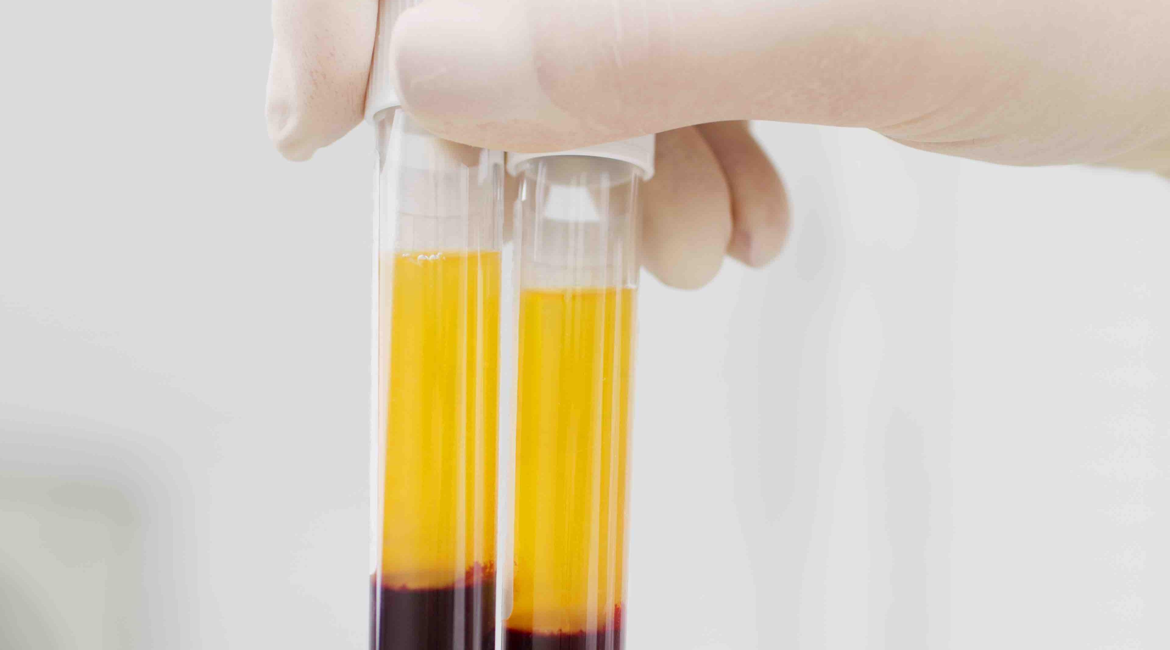 Platelet-Rich Fibrin (PRF) may lead to better outcomes with fat grafting, according to experimental study 