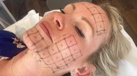 Treatment review – Thermage FLX