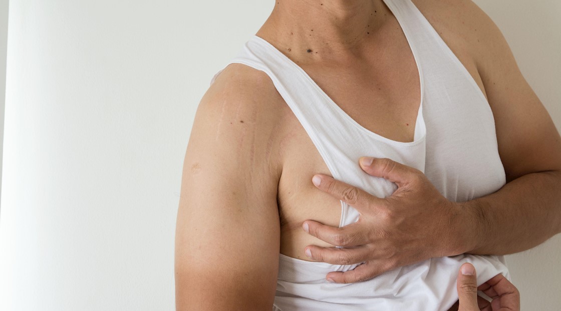 Male chest surgery interest has almost doubled in the past year